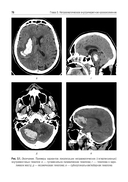 Ишемический инсульт и нетравматическое внутричерепное кровоизлияние. Формализованные протоколы описания РКТ- и МРТ-исследований — фото, картинка — 7